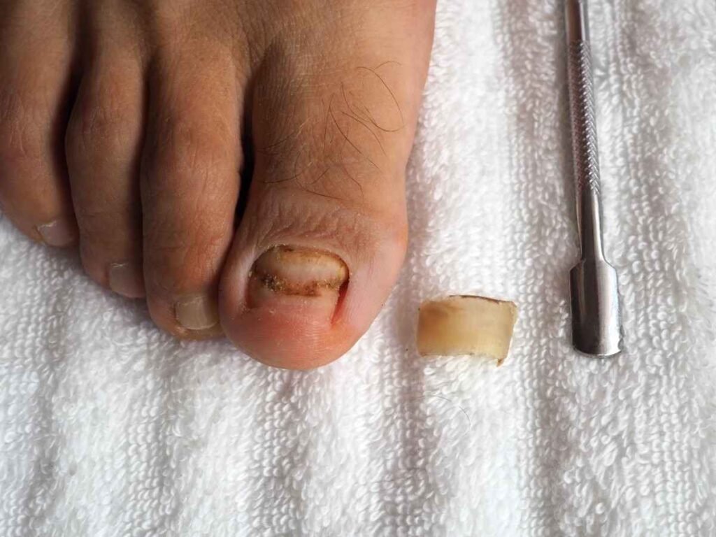 Ingrown Toenail Self-Care How to Fix and Prevent It