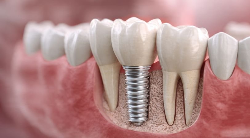 6 Signs You Need a Dental Implant in Peabody
